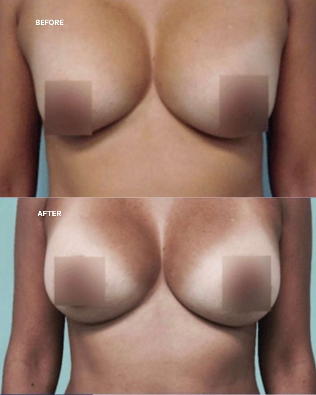 Breast surgery before and after — 1010 Plastic Surgery