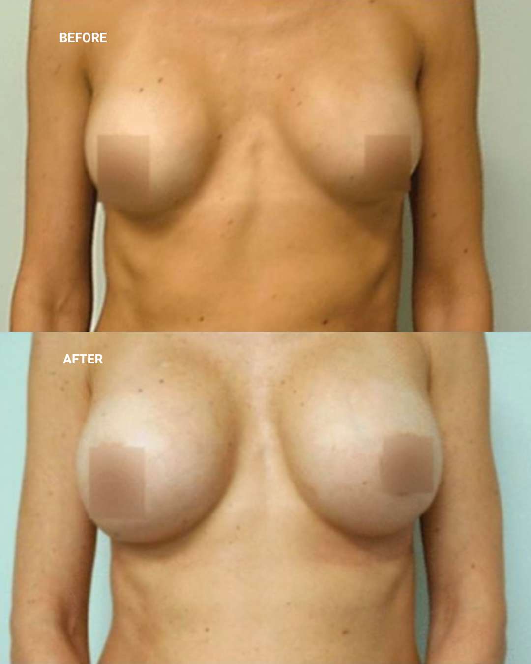 Breast surgery before and after — 1010 Plastic Surgery