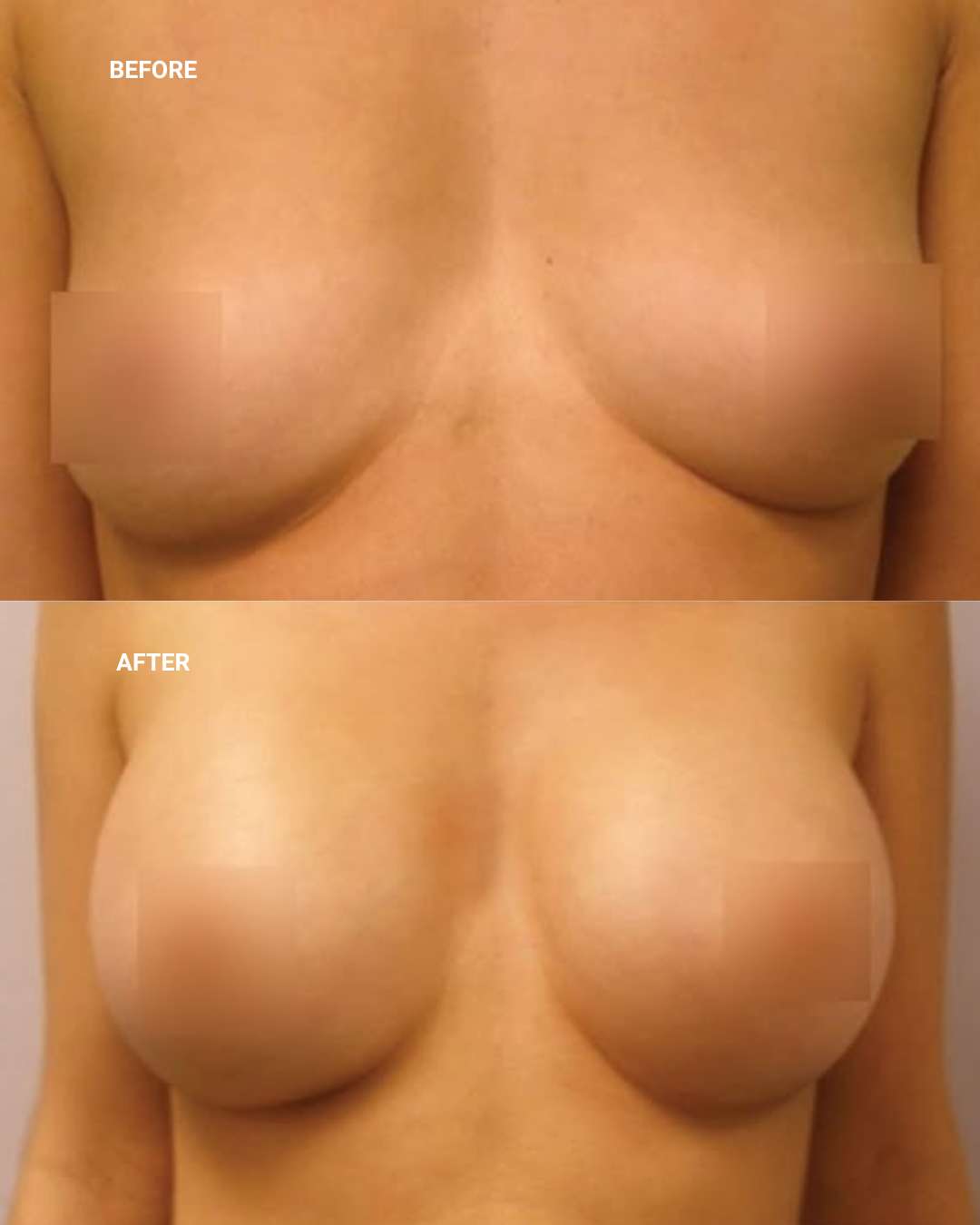 Breast surgery before and after — 1010 Plastic Surgery