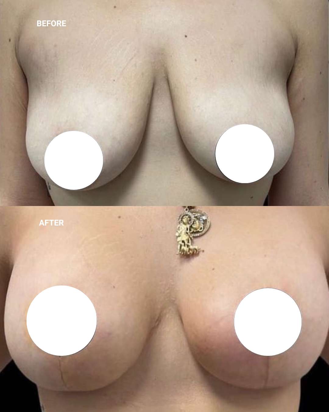 Breast surgery before and after — 1010 Plastic Surgery