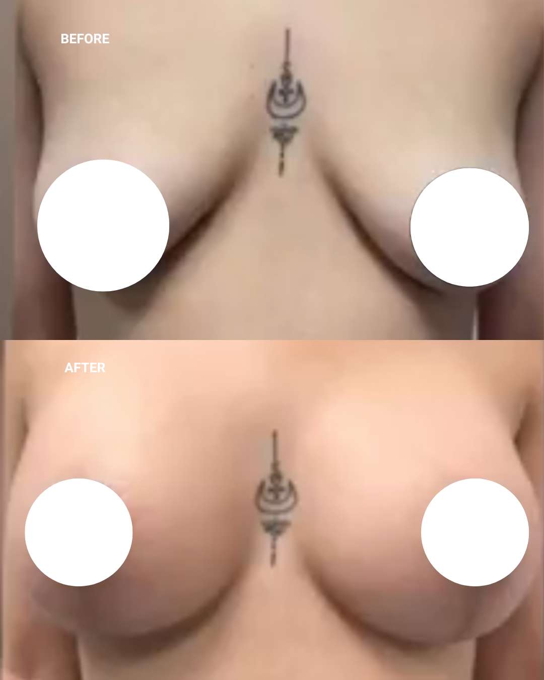 Breast surgery before and after — 1010 Plastic Surgery