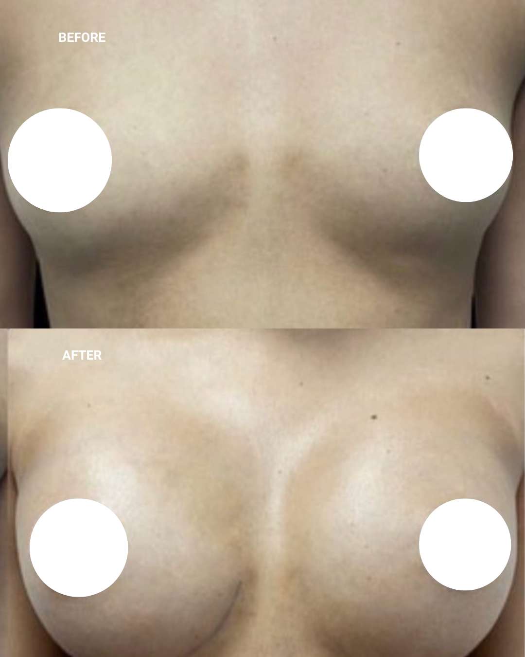 Breast surgery before and after — 1010 Plastic Surgery