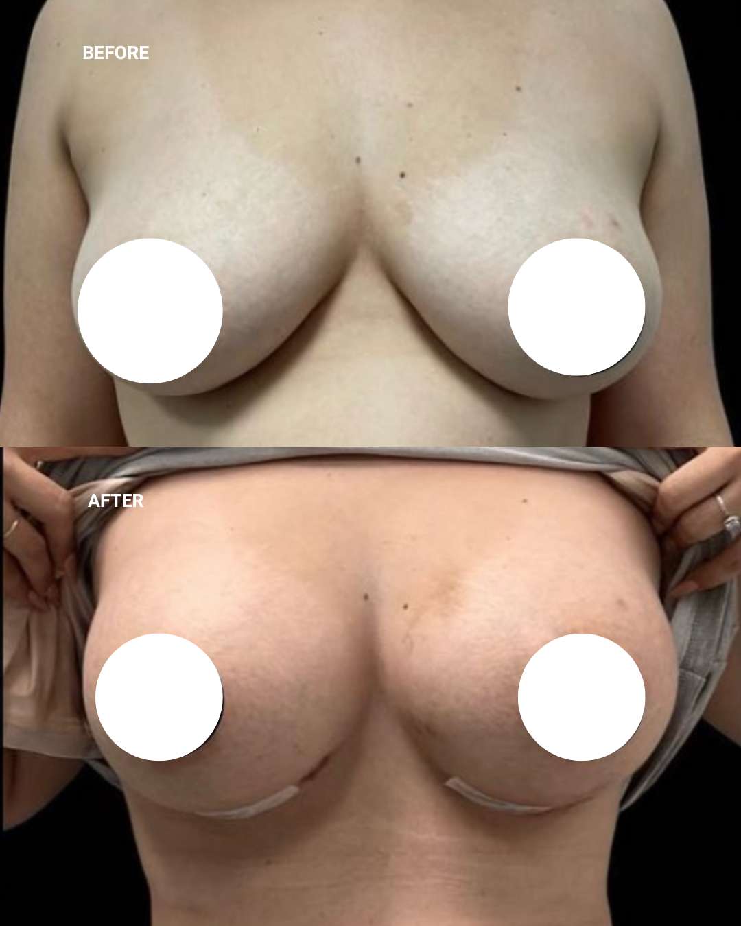Breast surgery before and after — 1010 Plastic Surgery