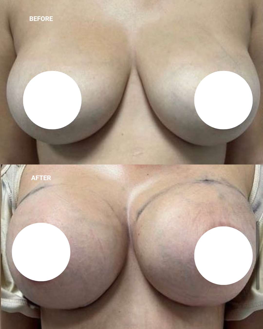 Breast surgery before and after — 1010 Plastic Surgery