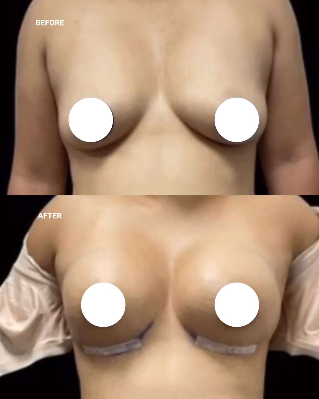 Breast surgery before and after — 1010 Plastic Surgery
