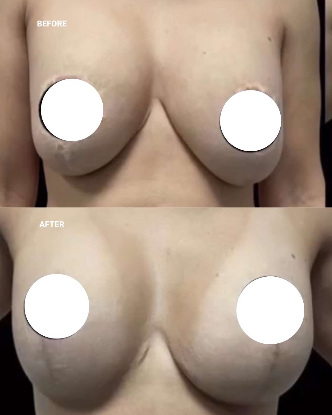Breast surgery before and after — 1010 Plastic Surgery