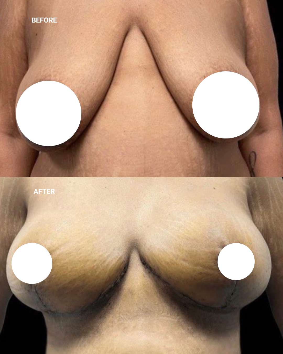 Breast surgery before and after — 1010 Plastic Surgery